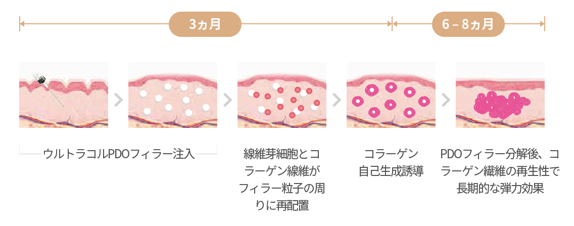 3개월, 6-8개월, 울트라콜 PDO 필러 주입, 섬유아세포와 콜라겐 섬유들이 필러 입자 주위로 재배치, 콜라겐 자가 생성 유도, PDO 필러 분해 후 콜라겐 섬유 재생성으로 장기적인 탄력 효과